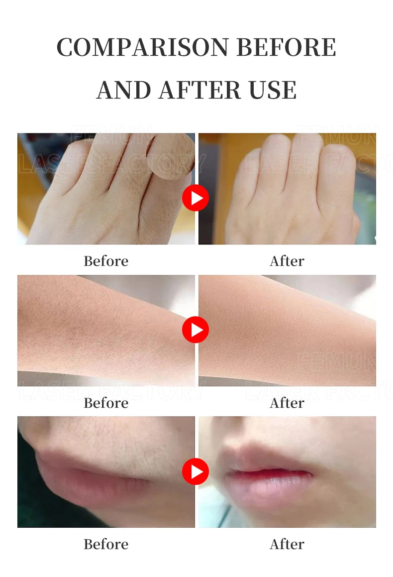 2025 Professional 808nm Epilator 4000W Painless Ice Platinum Diode Laser Hair Removal Machine 4 Wavelength Home Use And Salon